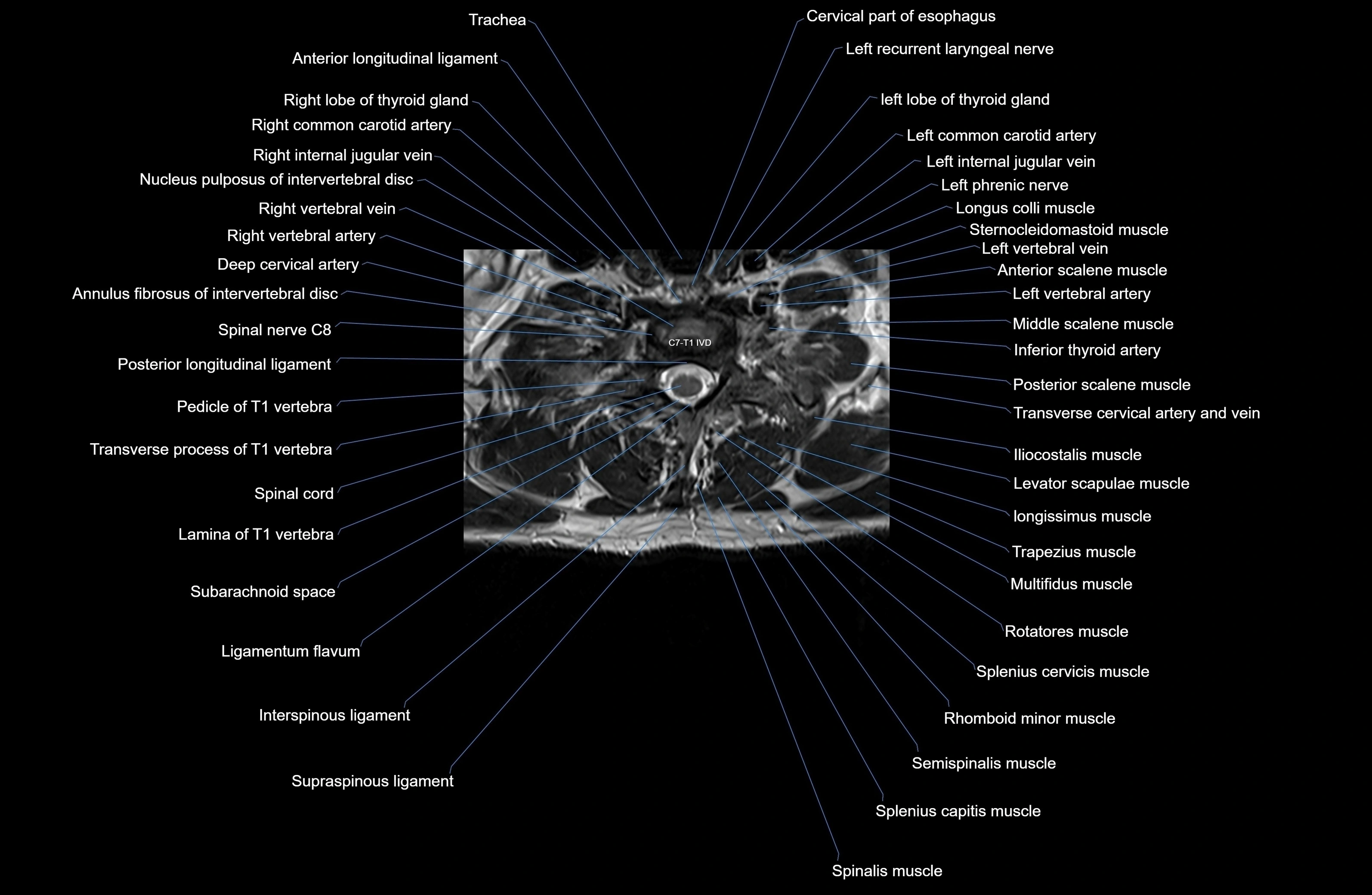 MRI thoracic spine axial  cross sectional anatomy 3T radiology  image-img-00001-00007.webp